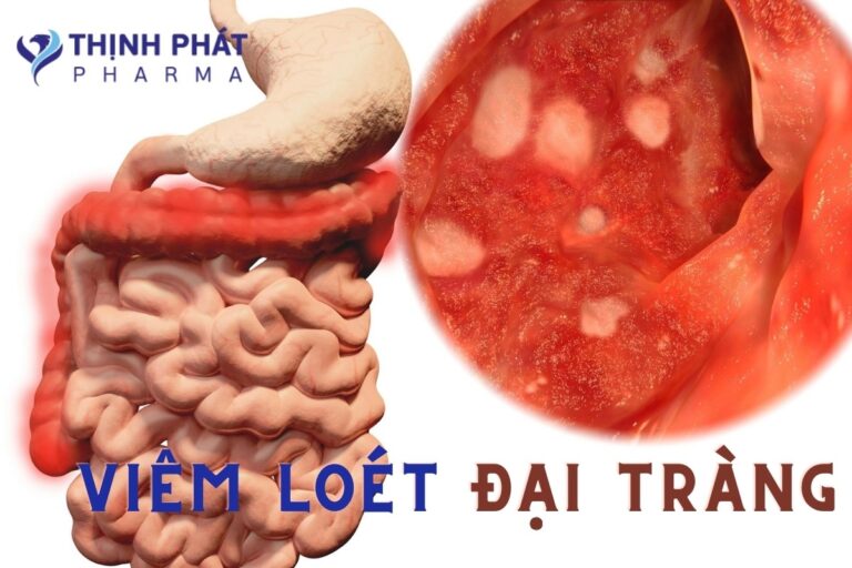 Viêm loét đại tràng